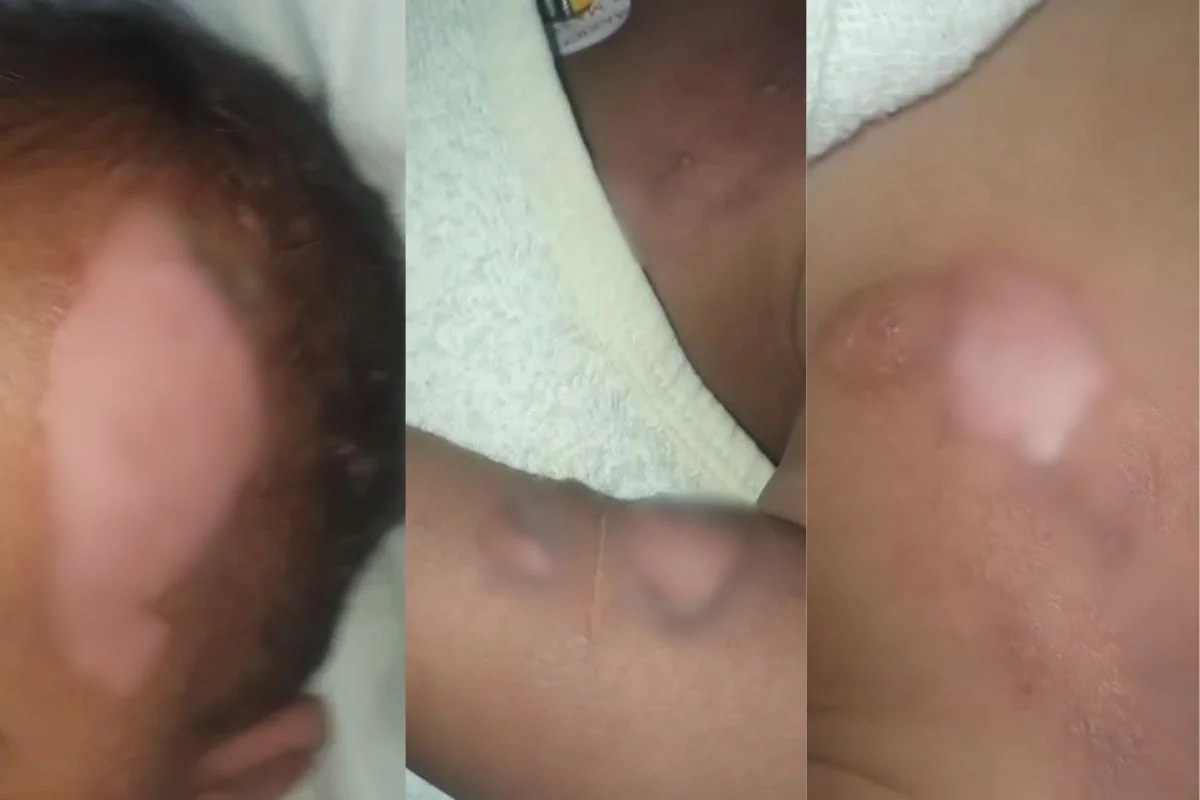 Bebê é internado em estado grave após sofrer queimaduras em creche no Paraná